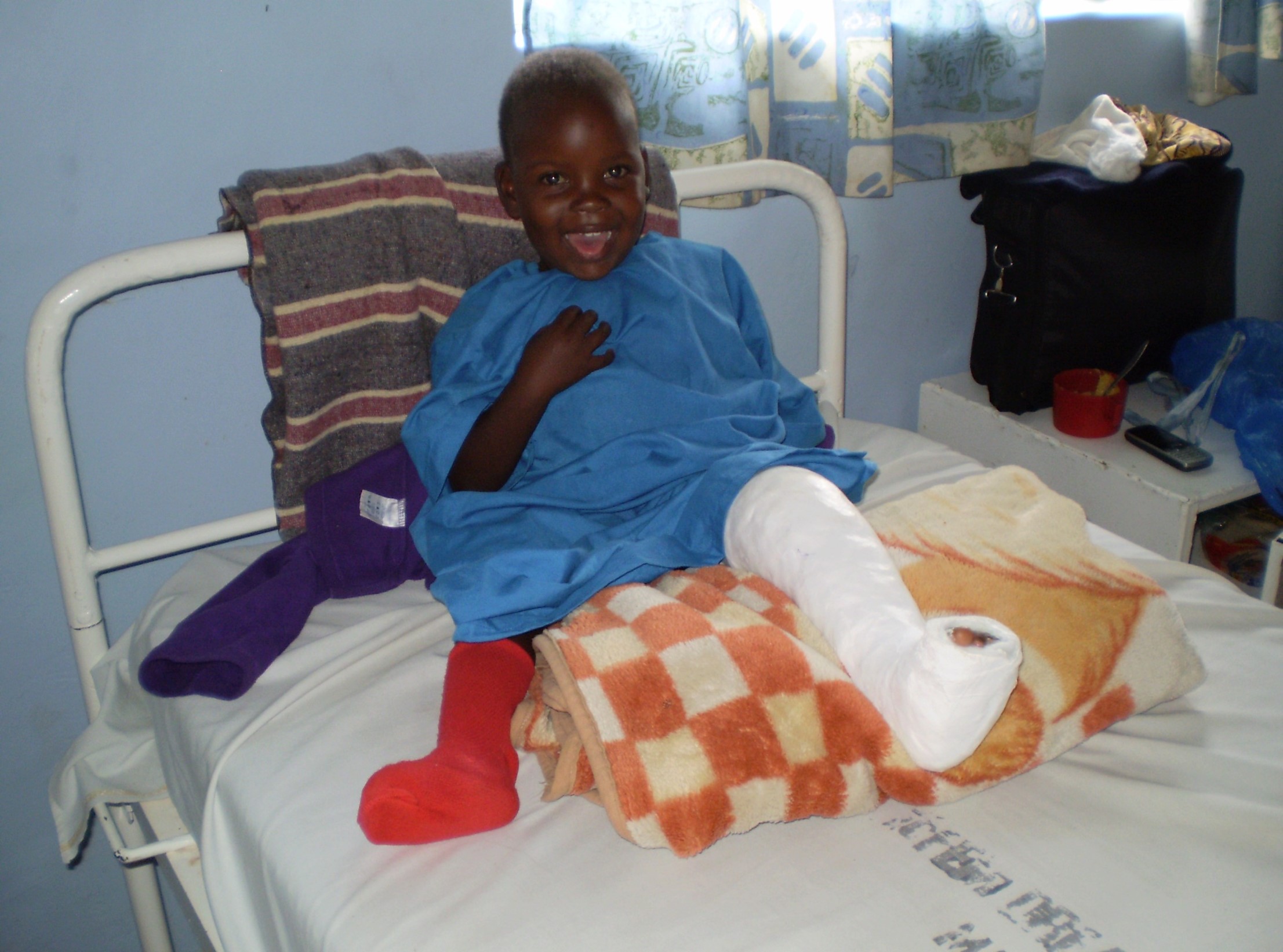 Club foot smiling kid